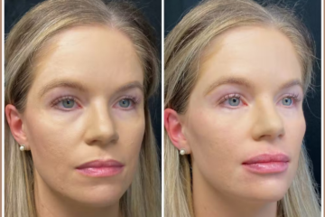 half syringe lip filler before and after aestheticlipsinfo.com