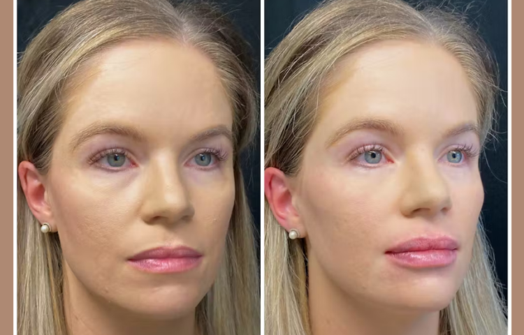 half syringe lip filler before and after aestheticlipsinfo.com