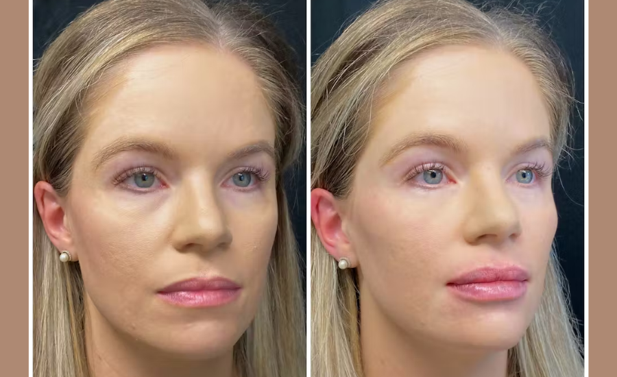 half syringe lip filler before and after aestheticlipsinfo.com