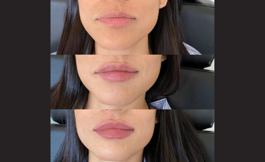 half syringe lip filler before and after aestheticlipsinfo.com