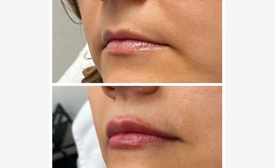 half syringe lip filler before and after aestheticlipsinfo.com